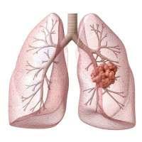 У некурящих найден ген рака легких